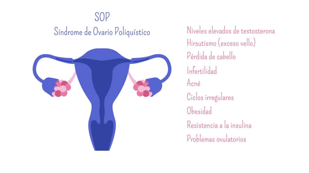 síndrome de ovario poliquístico